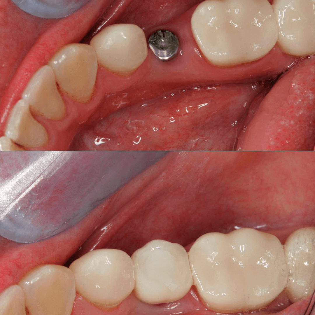 Implante dental